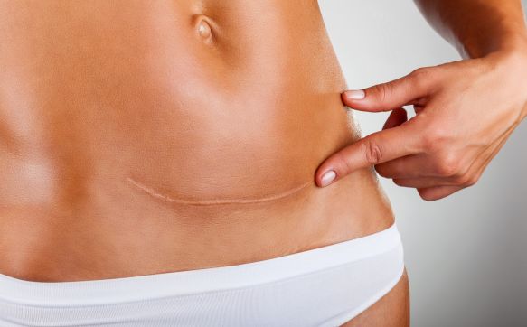 Das Bild zeigt den unteren Bauch einer Frau mit einer sichtbaren Narbe.