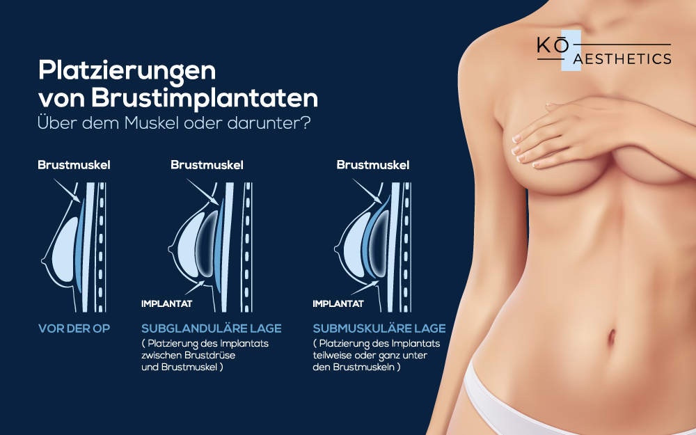 Unterschiedliche Platzierung von Brustimplantaten - KÖ Aesthetics Düsseldorf