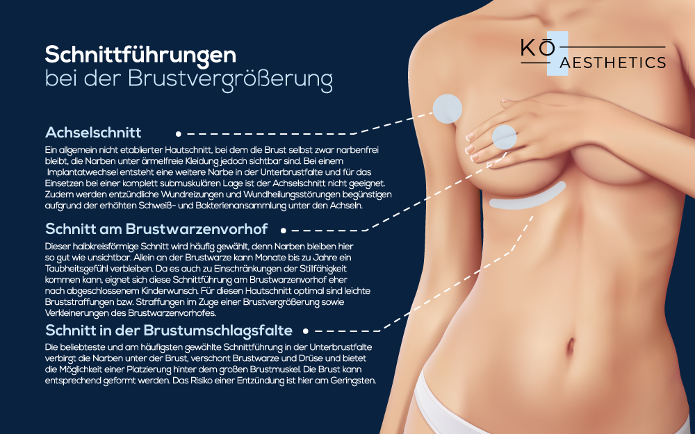 Unterschiedliche Schnittführungen beim Einsetzen des Brustimplantats bei KÖ Aesthetics Düsseldorf